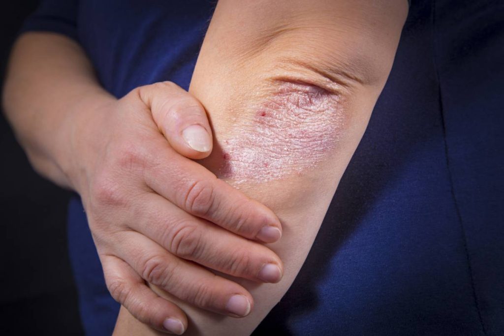 solutions traitement psoriasis